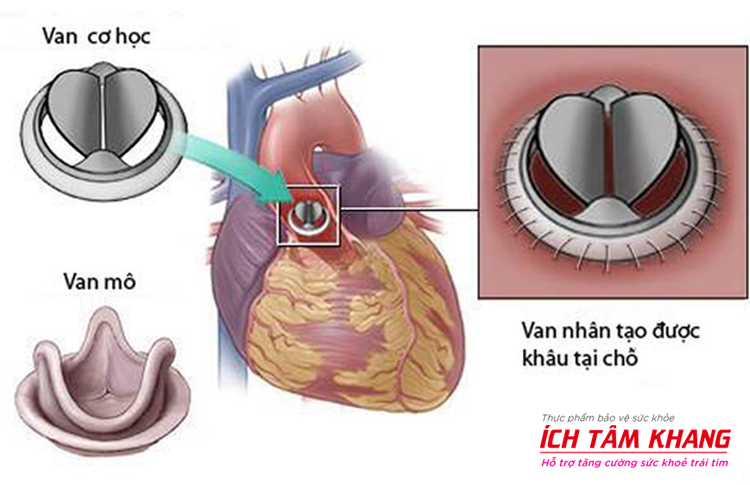 Thay van tim là biện pháp điều trị cuối cùng của hở van động mạch phổi